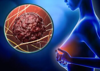 AstraZeneca: résultats prometteurs dans le cancer du sein