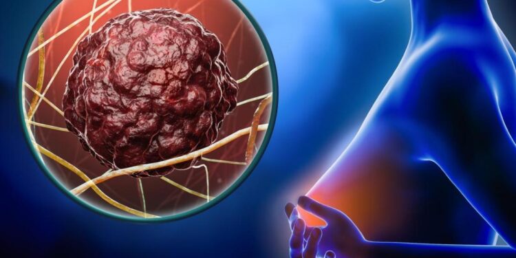 AstraZeneca: résultats prometteurs dans le cancer du sein