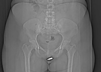 Une jeune femme de 24 ans reçoit une balle perdue dans son clitoris dans son salon