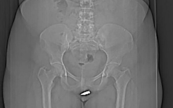 Une jeune femme de 24 ans reçoit une balle perdue dans son clitoris dans son salon