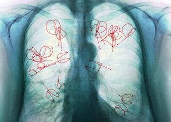 Lancement d’une Campagne de Sensibilisation Nationale contre la tuberculose