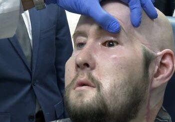 Première greffe complète d’un œil : Une percée médicale révolutionnaire