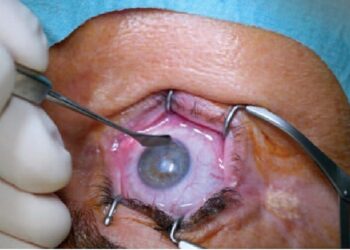 Drame à Rabat : Un faux médecin ophtalmologue à l’origine de la perte de vue d’un homme