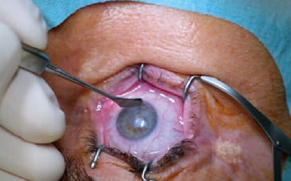 Drame à Rabat : Un faux médecin ophtalmologue à l’origine de la perte de vue d’un homme