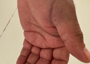 Refus de soins en Espagne : Un touriste marocain refoulé des urgences