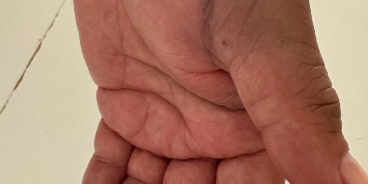 Refus de soins en Espagne : Un touriste marocain refoulé des urgences