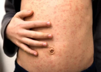 Rougeole à Chichaoua : Appel urgent aux autorités pour contenir l’épidémie