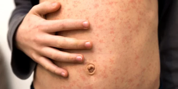 Rougeole à Chichaoua : Appel urgent aux autorités pour contenir l’épidémie