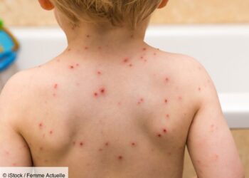 Recrudescence de la rougeole au Maroc : une urgence sanitaire nationale