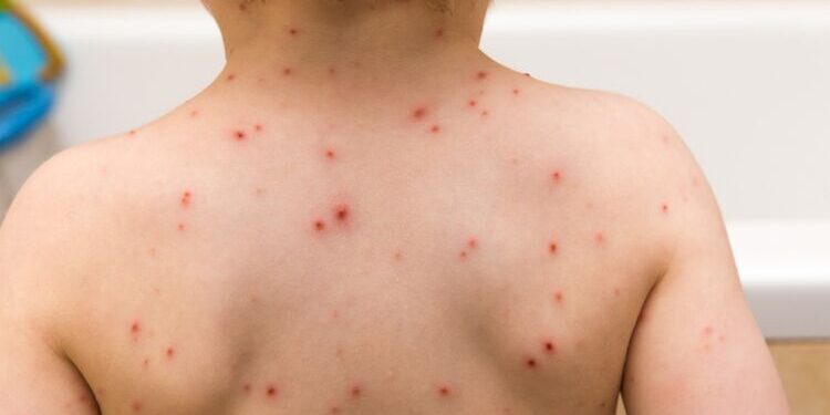 Recrudescence de la rougeole au Maroc : une urgence sanitaire nationale