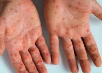 Le ministère de la Santé enregistre une baisse des cas de rougeole (Bouhamroun)